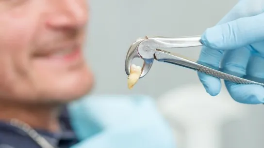 Day 2 Pain Free Tooth Extraction With Quick Recovery