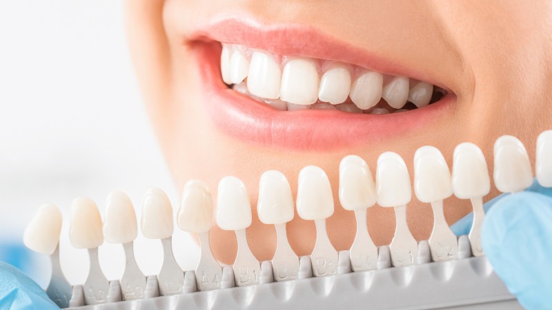 Day 2 Achieve A Brighter Smile With Professional Teeth Whitening